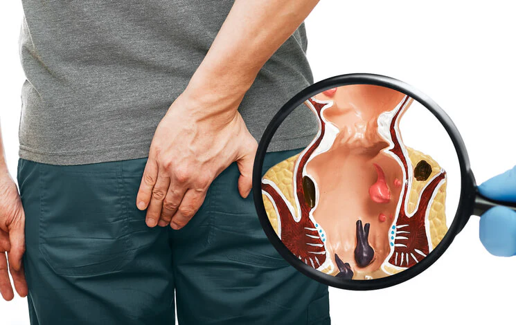 Piles — swollen anal vessels