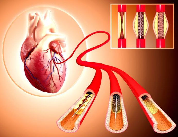 Coronary Angiography