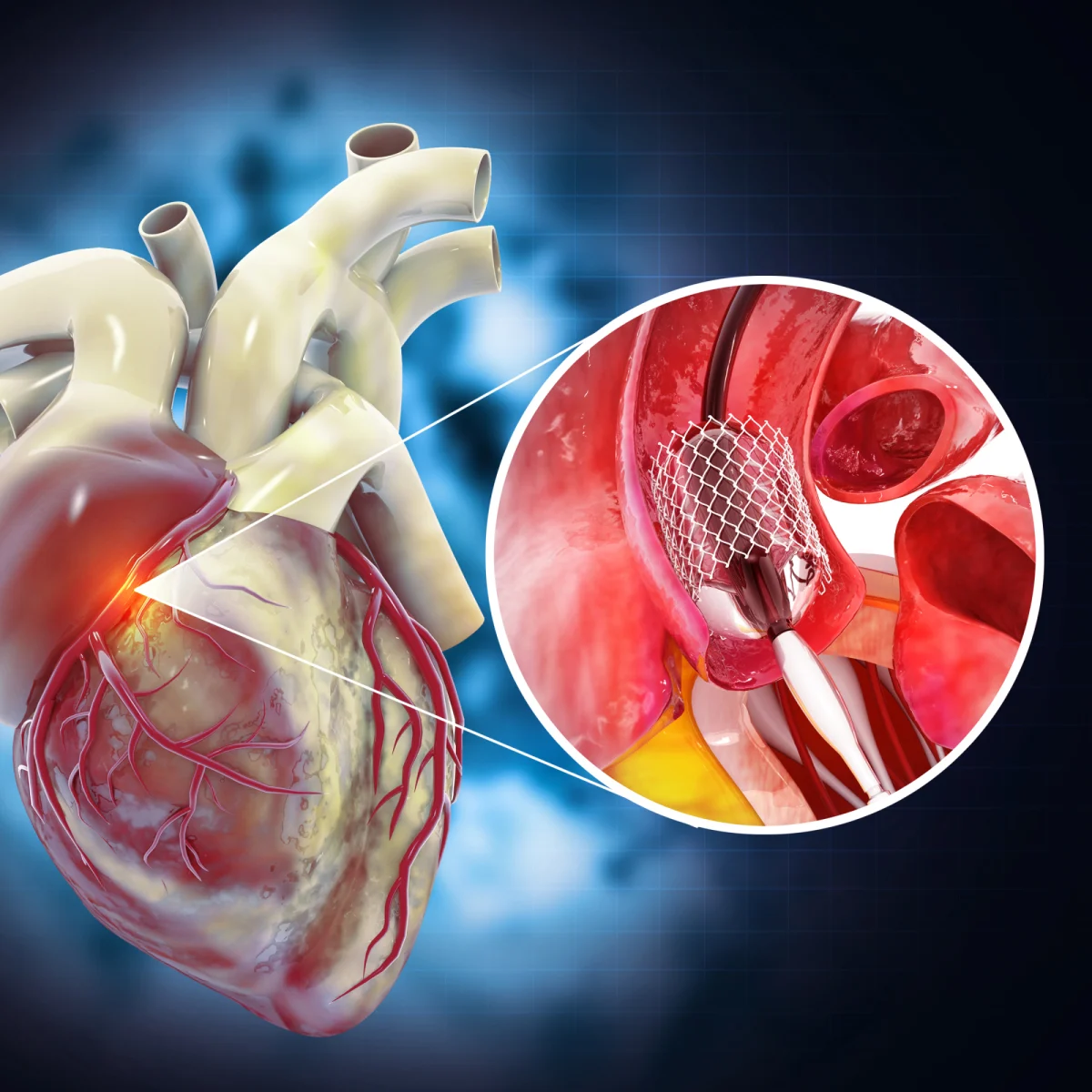 Interventional Cardiology