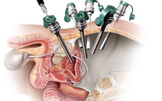 Prostate Surgery