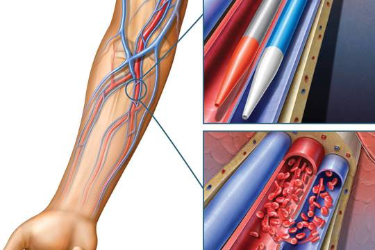 A-V Fistula Formation
