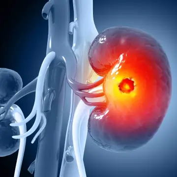 Renal Transplant
