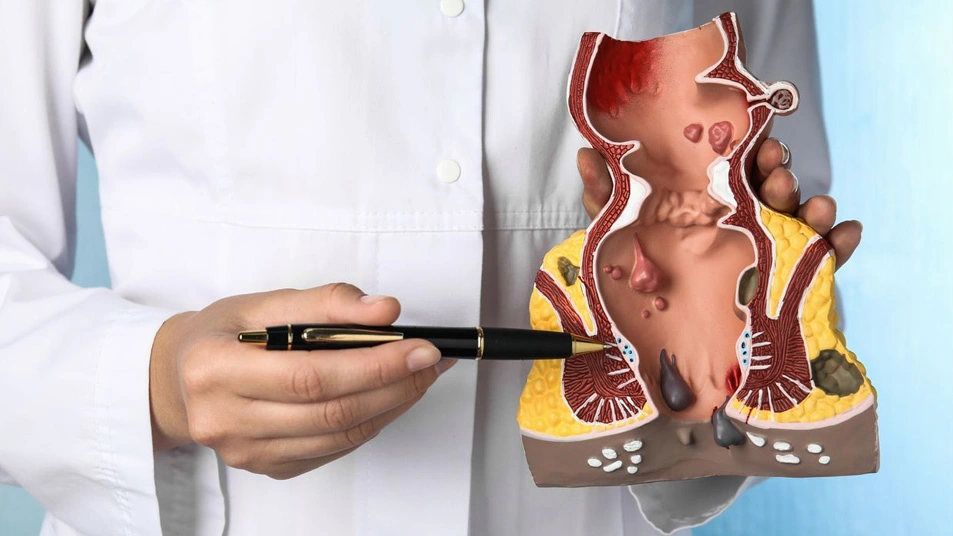Laser Fissure Surgery
