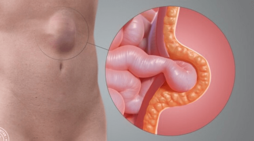 Laparoscopic Hernia Surgery