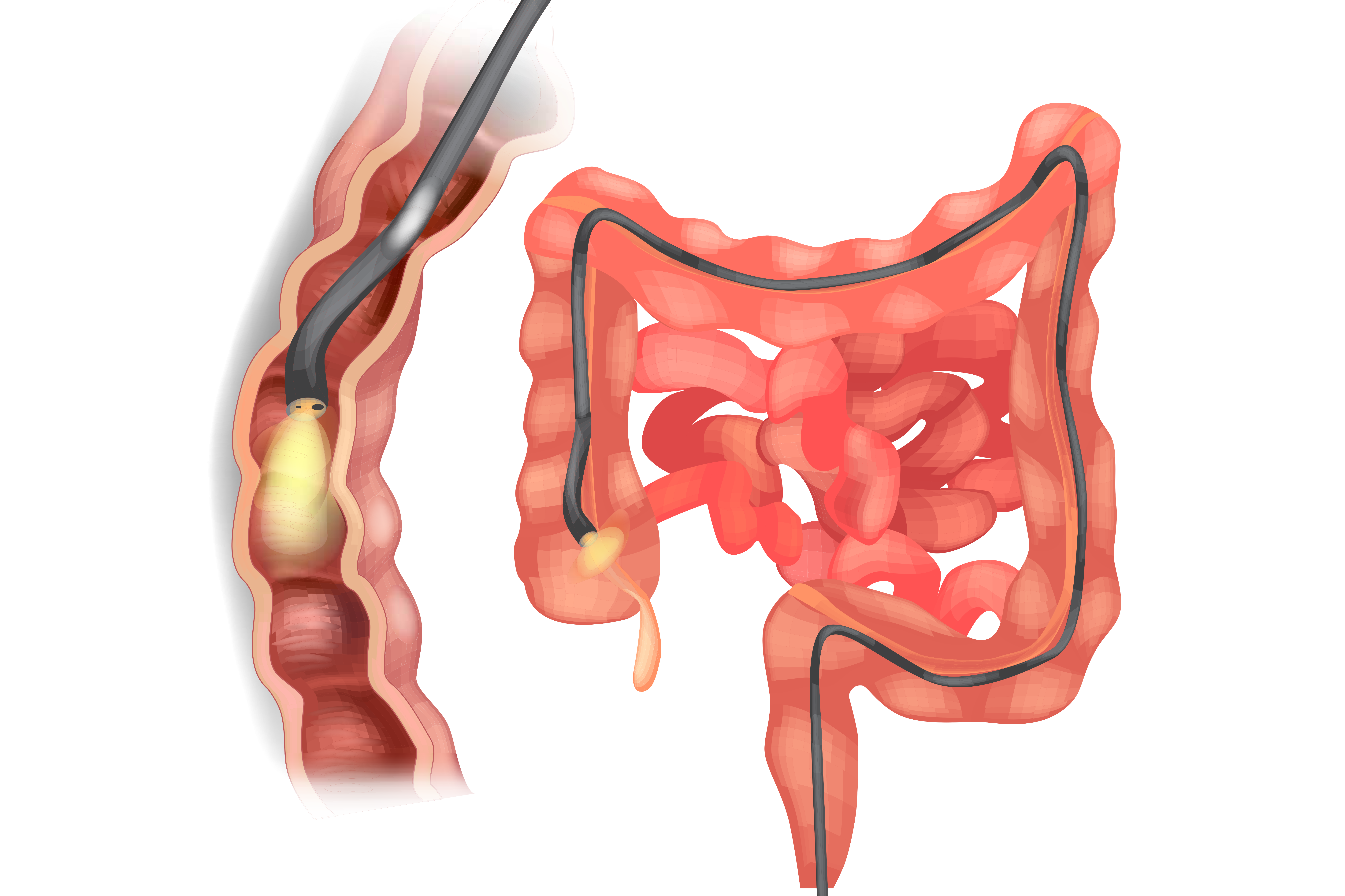 Colonoscopy